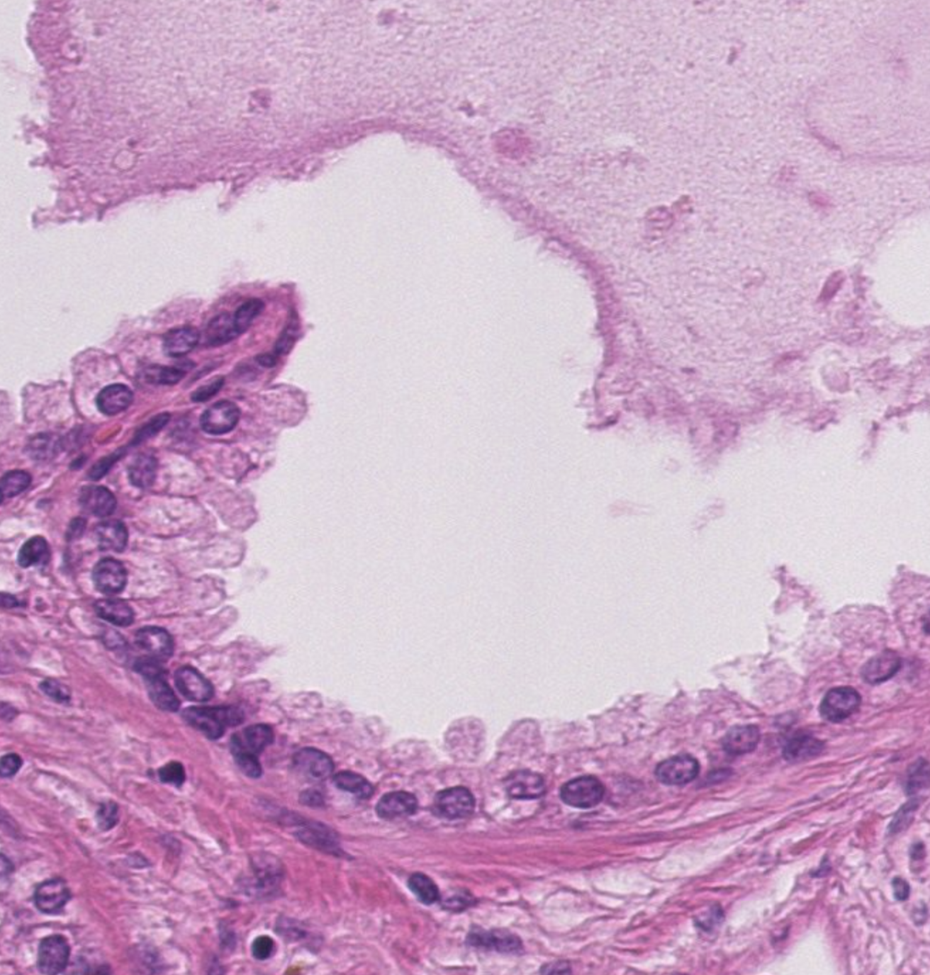 Histopathologisches Bild: Prostatahyperplasie mit knotiger Architektur